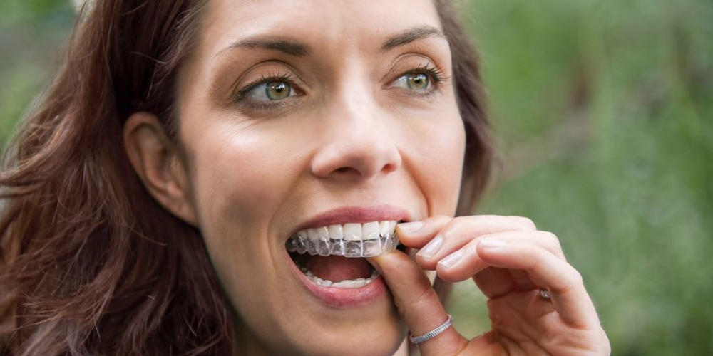 Benefícios da Invisalign para Ortodontia